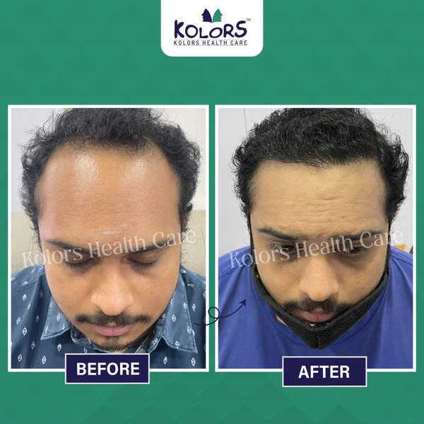 Young Man Before and After Hair Treatment