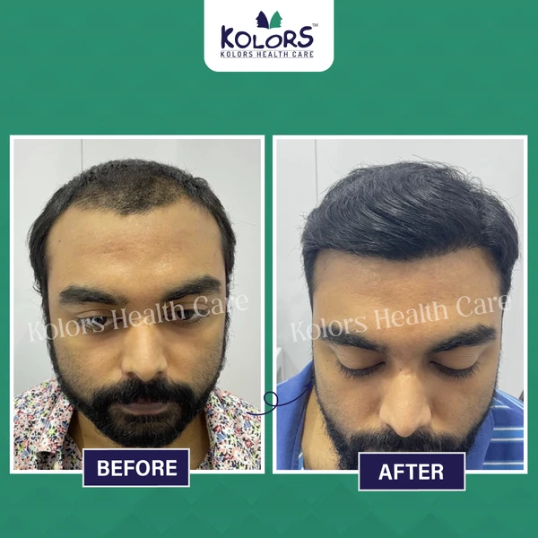 Before and
                After Hair Treatment