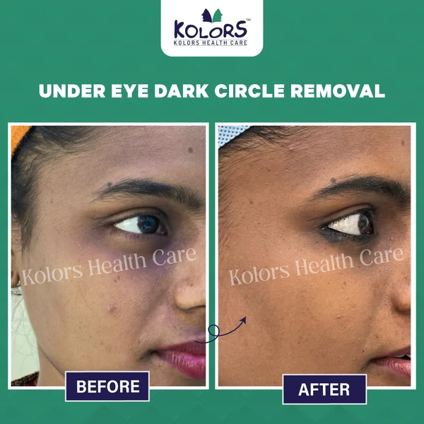 Skin Treatment Before and After Pictures