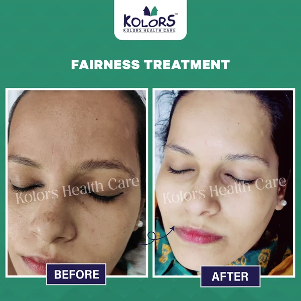 Young girl Before and After Skin Treatment