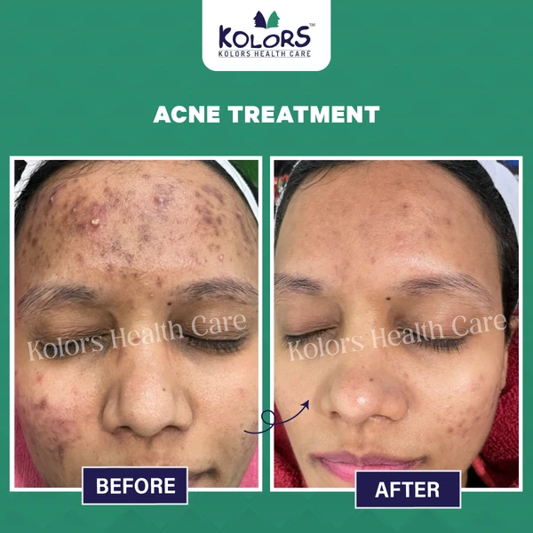 Woman Face Before and After Skin Treatment