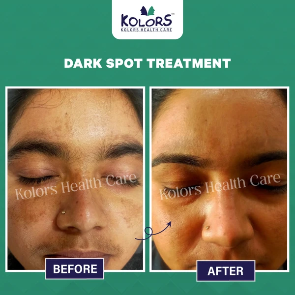 Woman Face Before and After Skin Treatment