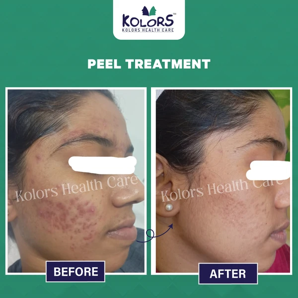 Woman Face Before and After Skin Treatment