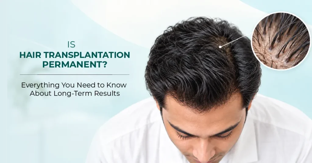 Is Hair Transplantation Permanent?